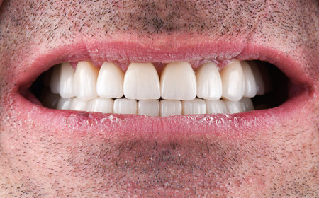 Emax crowns and veneers on teeth and implantsの写真素材
