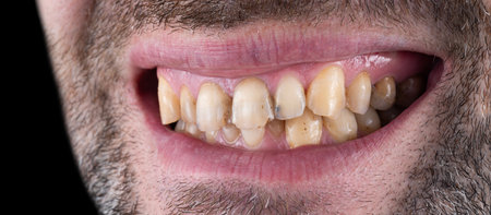 porcelain crowns and veneersの写真素材