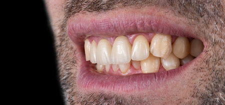 porcelain crowns and veneers