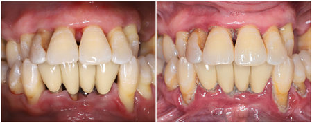 teeth and gums deep cleaningの写真素材