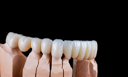 emax ceramic cowens on implantsの写真素材