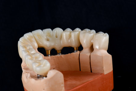 emax ceramic cowens on implantsの写真素材