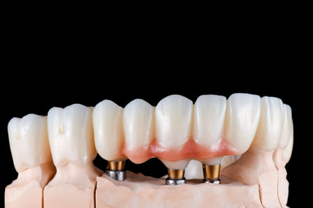 emax ceramic cowens on implantsの写真素材