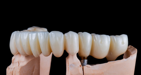 emax ceramic cowens on implantsの写真素材