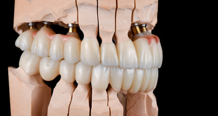 emax ceramic cowens on implantsの写真素材