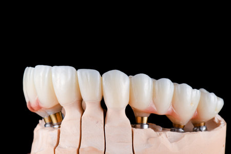emax ceramic cowens on implantsの写真素材