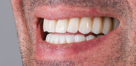 emax ceramic cowens on implantsの写真素材