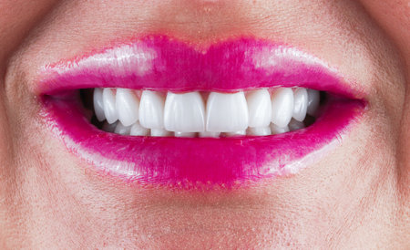 beautiful smile with veneer teethの写真素材