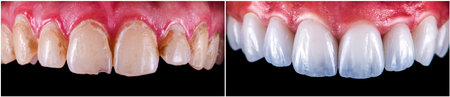 teeth restoration with ceramic veneers