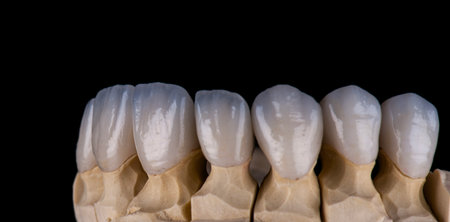 ceramic emax crowns and veneers bl4 color