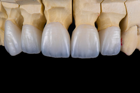 ceramic emax crowns and veneers bl4 color