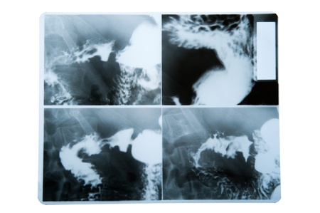 object on white - X-ray image of stomach