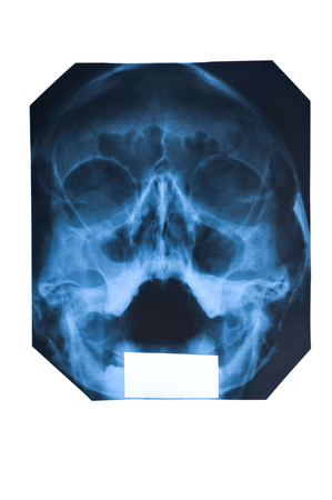 x-ray of face and maxillary sinuses isolated on white