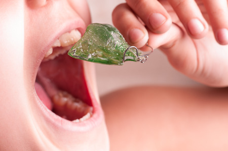 The girl sets in her mouth green orthodontic treatment heldの写真素材