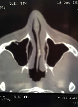 X-ray image of the face curvature of the nasal septumの写真素材