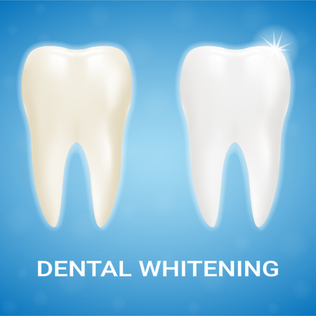 Tooth Veneer, Teeth Whitening, Whitening Toothpaste Isolated On A Background. Realistic Vector Illustration. Healthcare stomatology and cleaning professional teeth illustrationのイラスト素材