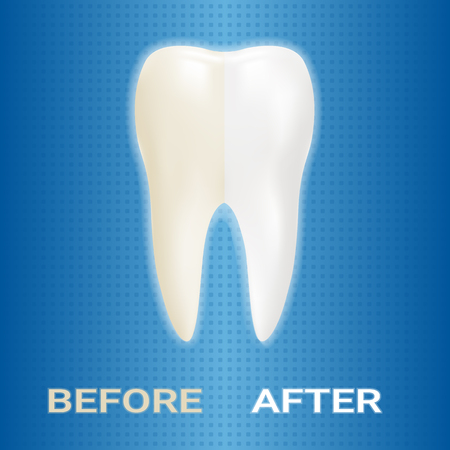 Dental Veneer, Whitening Of Human Tooth, Whitening Toothpaste Isolated On A Background. Realistic Vector Illustration. Healthcare stomatology and cleaning professional teeth illustration.のイラスト素材