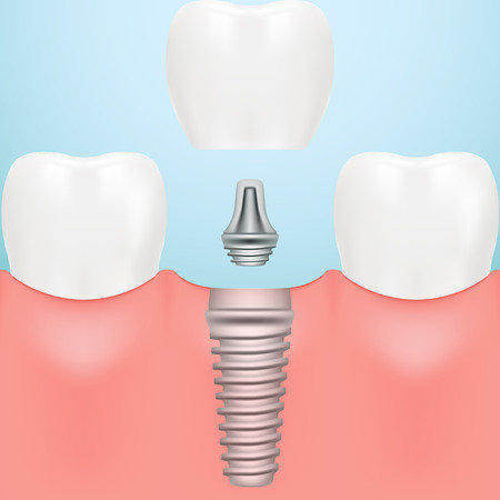 Tooth Human Implant. Dental Concept. Human Teeth Or Dentures Isolated On A Background. Vector Illustration. Stomatology. Creative Medical Conceptのイラスト素材
