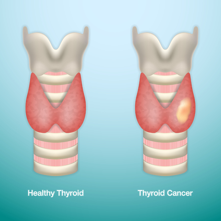 Healthy Thyroid and Thyroid Cancer. Vector Illustration.のイラスト素材