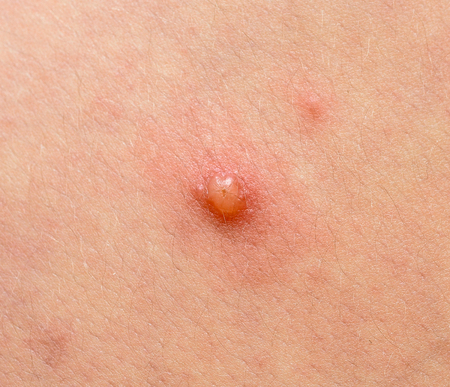 Varicella zoster virus or Chickenpox bubble rash on child, baby or adoult. Closeup image of a fresh blisterの写真素材