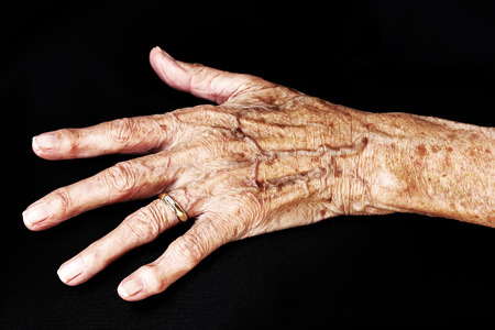 The aching hand of an old woman. An old woman has pain in his hands. The hand of an old womanの写真素材