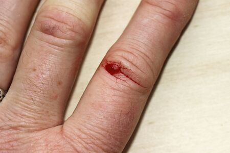 A bleeding injury on a woman's finger. A bleeding wound on the handの写真素材