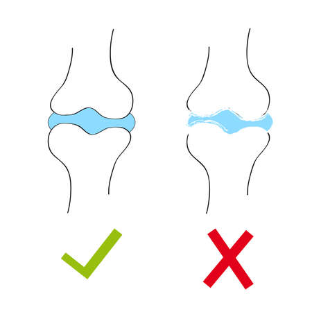 Joint with cartilage and arthritis.Vector illustration.のイラスト素材