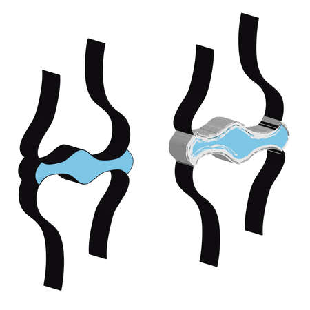 3D joint with cartilage and arthritis.Vector illustration.のイラスト素材