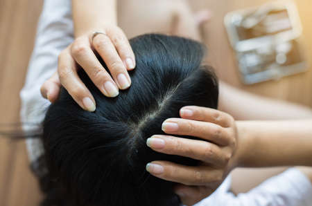 Young woman shows her dandruff on hair roots,Selective focusの写真素材