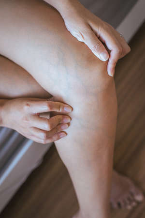 Varicose veins on the female leg,Close up