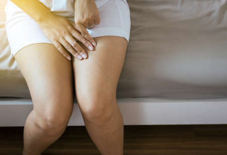 Varicose veins on the womans legs,Close up