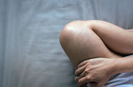 Varicose veins on the womans leg,Concept skin healthの写真素材