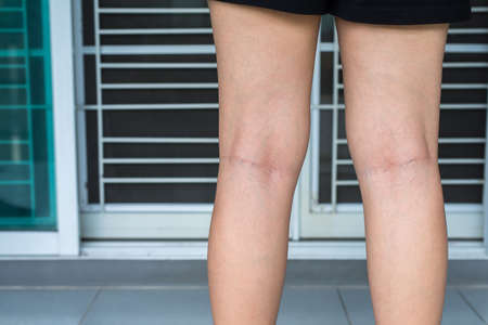 Varicose veins on the womans leg,Normal veins near the skin layer swell out,And blood is accumulated...