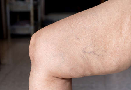 Vascula,Body and health care concept,Varicose veins on senior woman leg or foot,Close upの写真素材