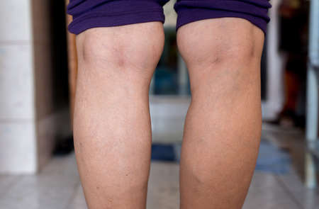 Body and health care concept,Varicose veins on the womans legs or foots,Close upの写真素材