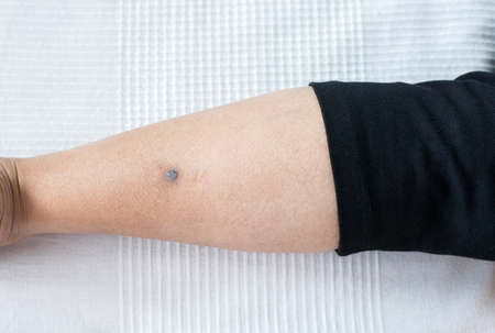 Woman with acne scars black color with problematic problem skin on leg close upの写真素材