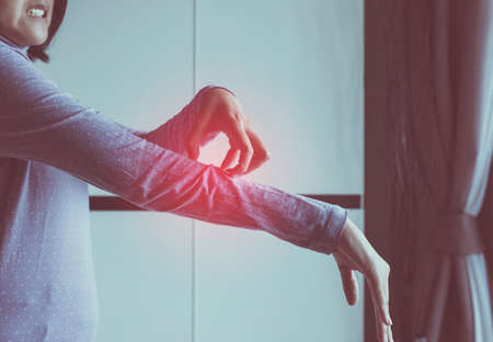 Woman with rash or papule and scratch on her arm from allergies, Health allergy skin care problemの写真素材