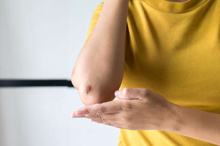 Woman showing wound on her arm,Scab Becomes Infectedの写真素材