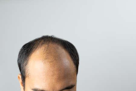 Close up man head of hair loss