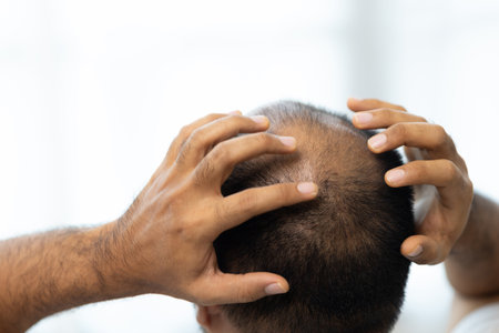 Close up man hair loss. Young man itchy head There is a fungus on the scalp dandruff red rash be...
