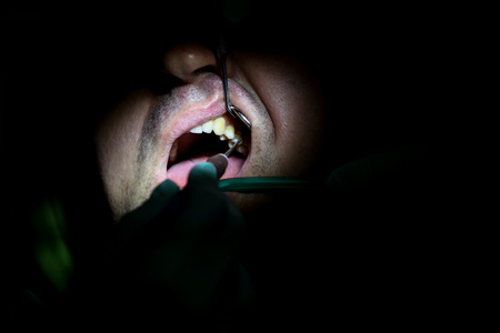 Bucharest, Romania - February 5, 2019: Details with the hands of a woman dentist, with surgical gloves, working with specific tools inside the mouth of a patientのeditorial素材