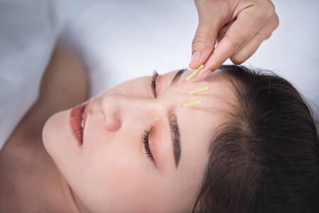 young woman undergoing acupuncture treatment on headの写真素材