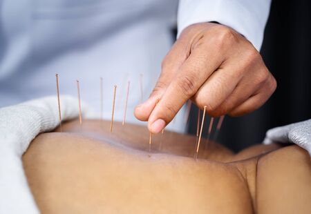 Close-up of senior female back with steel needles during procedure of the acupuncture therapyの写真素材