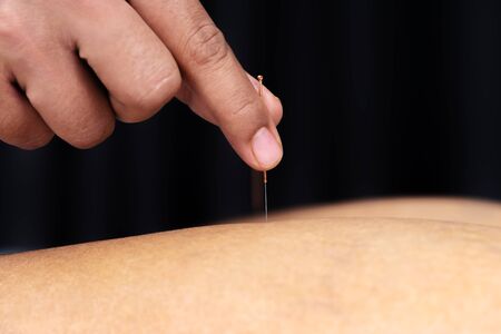 close up therapy of leg with pricking acupuncture needles