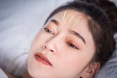 young woman undergoing acupuncture treatment on headの写真素材