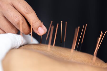 Close-up of senior female back with steel needles during procedure of the acupuncture therapyの写真素材