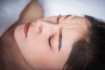 young woman undergoing acupuncture treatment on headの写真素材