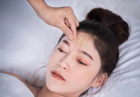 young woman undergoing acupuncture treatment on headの写真素材