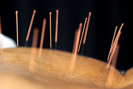 Close-up of senior female back with steel needles during procedure of the acupuncture therapyの写真素材
