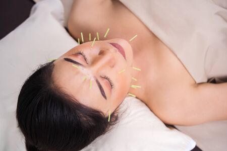 young woman undergoing acupuncture treatment on faceの写真素材